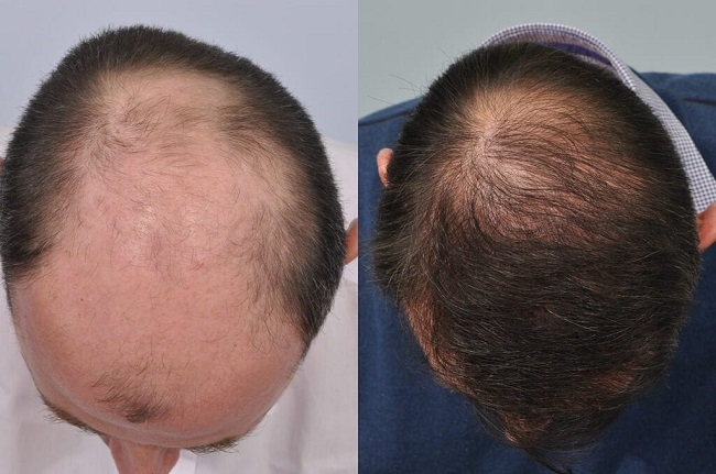 Hair Care After Hair Loss